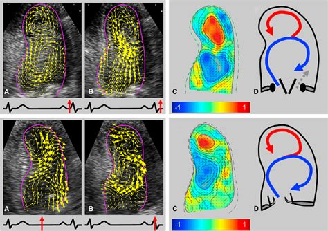 Flow Patterns In Patients With Bileaflet Valves In Anatomic Orientation