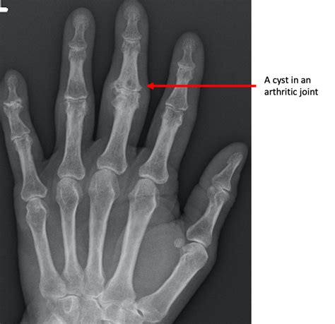 Xray Image Lumbar Spine Shows Osteoarthritis Stock Photo