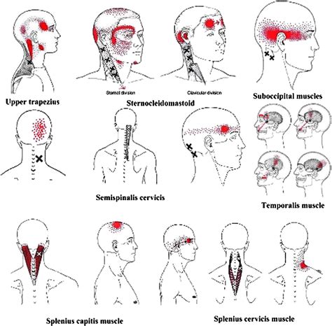 Suboccipital Muscles Pain Trigger Points Images