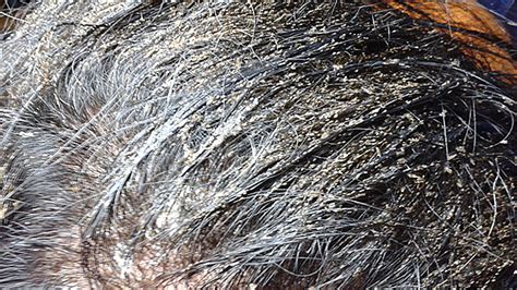 What Do Lice Look Like In Hair Home Design Ideas