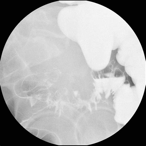 Diverticular Stricture Image