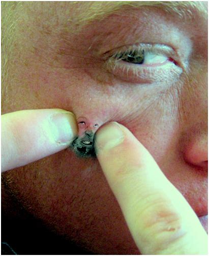 Try out these home remedies to watch your pimple inside the nose disappear in no time. Top 10 Ways To Remove Pimples | OMG Top Tens List