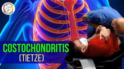Costochondritis Tietze Chiropractic Evaluation And Treatment Synergy