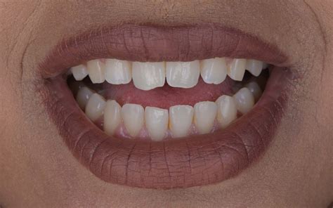 Tooth Contouring Cosmetic Dentistry London Marylebone Smile Clinic
