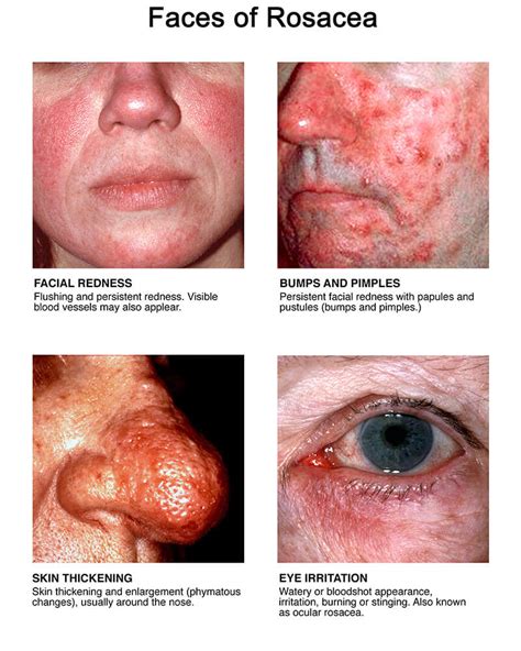 All About Rosacea Signs And Symptoms And Treatment 2022