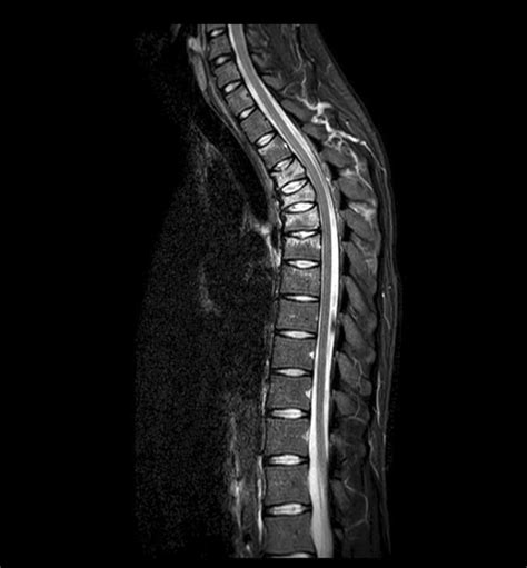 Mri Scan Confirming Multiple Compression Fractures Of Thoracic