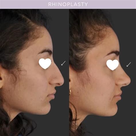 Nose Job Before And After Video Nose Job Rhinoplasty Nose Jobs