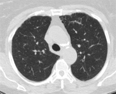 Nodules Endobronchial Lungs
