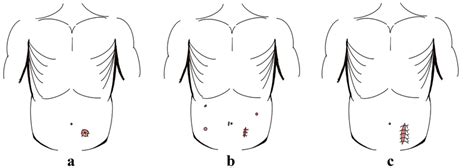 Schematic Diagram Of Surgical Procedure A The Colostomy Site Of Hp