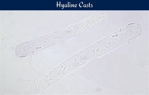 Hyaline Casts In Urine Morphology And Clinical Significance