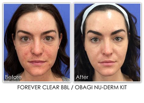 Forever Clear Acne Skin Rejuvenation Clinic Skin Rejuvenation Clinic
