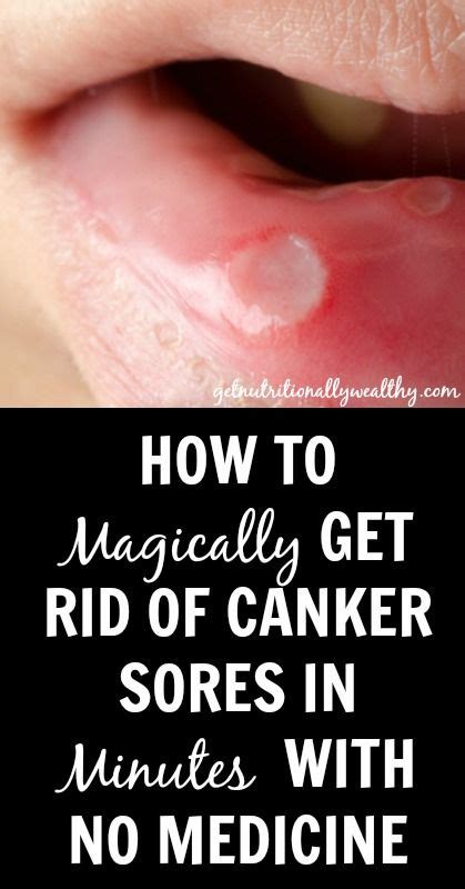 How To Naturally Get Rid Of Canker Sores In Minutes With
