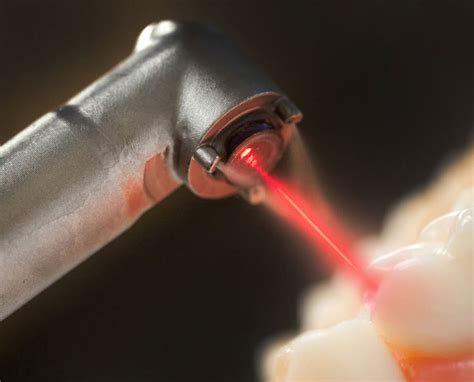 Methods Of Dental Cyst Treatment Surgery Laser Total Tooth Removal