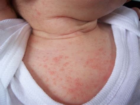 أنواع الأمراض الجلدية عند الأطفال وكيفية التشخيص والعلاج