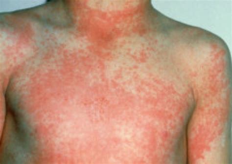 Scarlet Fever Symptoms Pictures Causes Tests Treatment
