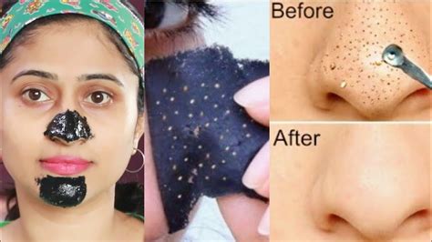 असे काढा Blackheads Whiteheads आणि चेहऱ्यावरचे केस Charcoal Peel Off