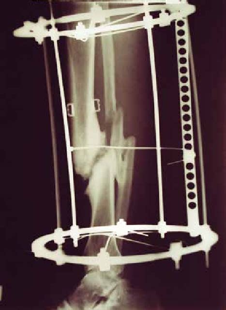 Non Union Of Tibial And Fibula Shafts Treated With Ilizarov External