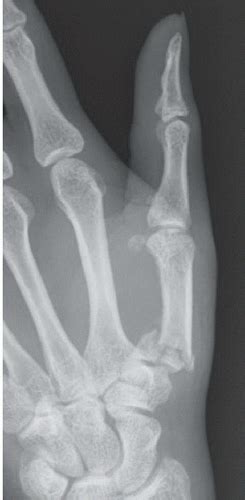 Base Of Thumb Metacarpal Fracture Radiology Key