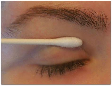 The fact that your son's eyes have been puffy from a very young age, but do not seem to trouble him suggest there is probably nothing serious causing it may be worth checking photos of you and your husband when you were young to see if either of you had a similar appearance. Natural Remedy For Drooping Eyelids, Sagging Eyelids or ...
