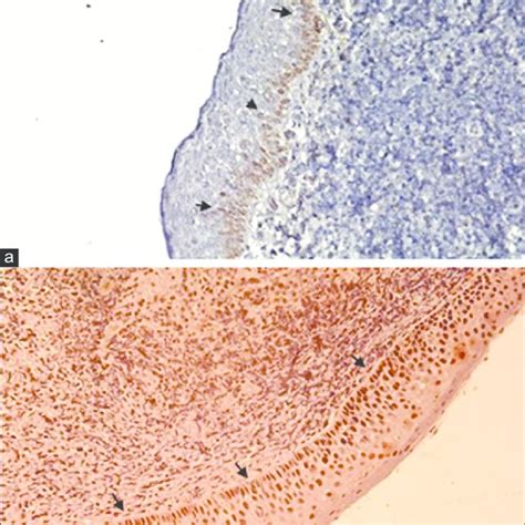Moderately Differentiated Squamous Cell Carcinoma Of The Vocal Cord