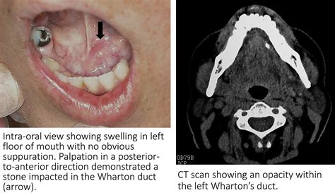 Obstructive Wharton Duct Sialadenitis Journal Of Emergency Medicine