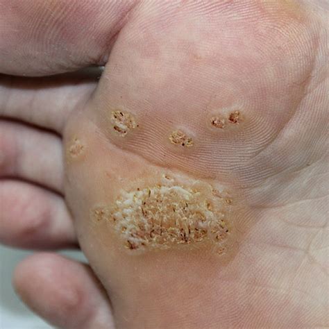 Plantar Warts Foot Lab Podiatry