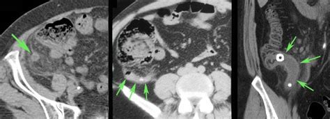 The Radiology Assistant Appendicitis Pitfalls In Us And Ct Diagnosis