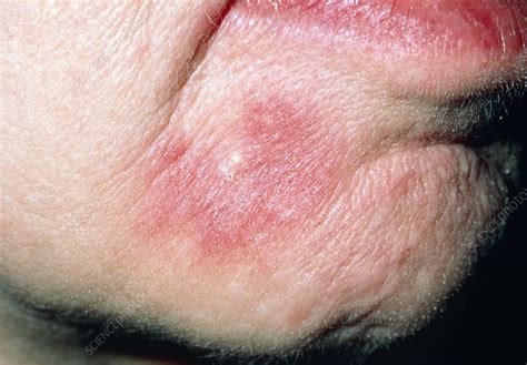 Systemic Lupus Erythematosis Lesion On The Face Stock Image M200