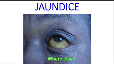 Jaundice Its Typespre Hepatic Hepatic And Post Hepatic Jaundice