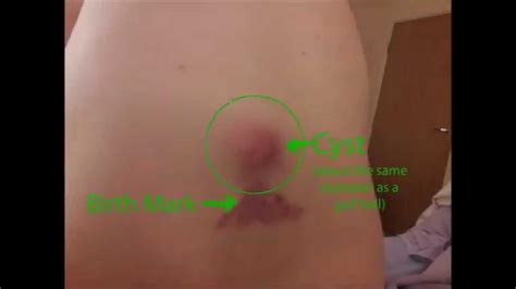 Sebaceous Cyst Erupting Possibly Abscess Youtube