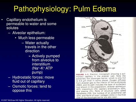 Ppt Chapter 7 Pulmonary Edema Powerpoint Presentation Free Download