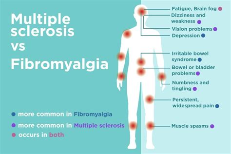 For example, miss is used for someone who is teaching at a school. Fibromyalgia vs. Multiple Sclerosis (MS): Differences in ...