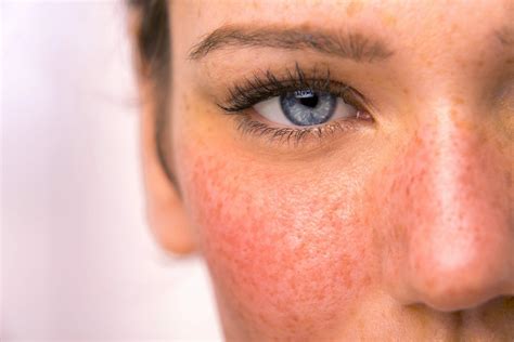 Rosacea Treatment Melbourne Victorian Laser And Skin Clinic