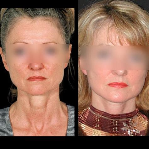 Lifting Du Visage Et Du Cou Chirurgie Esthétique Paris — Dr Gérald Franchi