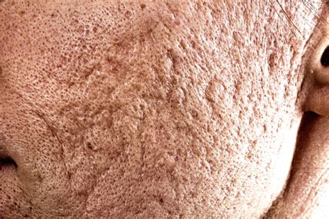 Atrophic Scar Formation In Acne Linked To Long Acting Immune Responses