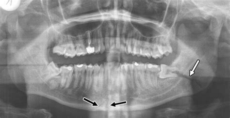 Mandibular Fracture X Ray