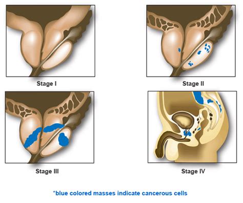 Health Tips Elephantiasis Lymphatic Filariasis Crabs Std Crabs