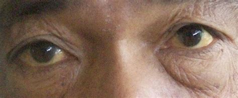 Yellow Eyes Jaundice Eyes Causes Symptoms And Treatments