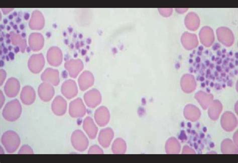 Peripheral Smear Shows Large Platelet Clumps Exclusivel Open I