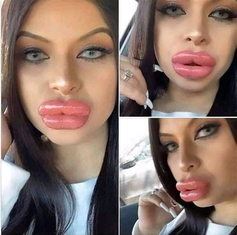 Bad Celebrity Plastic Surgery Bad Plastic Surgeries Fake Lips Big Lips Lip Surgery Botox