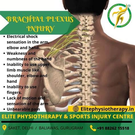 Brachial Plexus Injury Elite Physiotherapy And Sports Injury