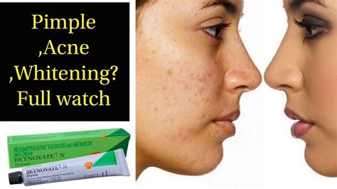 Betnovate N Cream Best Acne Treatment Oily Skin Pimple Clear Supriyatheclassytips Youtube