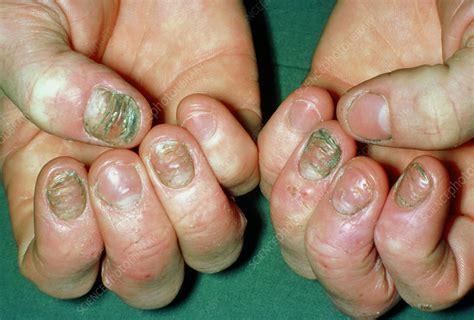 Eczema Affecting The Fingernails Stock Image M1500003 Science