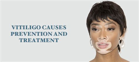 Vitiligo Causes Prevention And Treatment Medplusmart