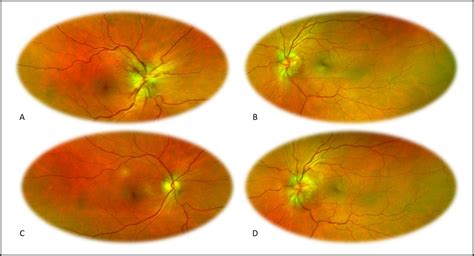 Parainfectious Optic Neuritis Followed By Microcystic Macular Oedema