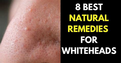 8 Best Natural Remedies To Remove Whiteheads That Work Fast