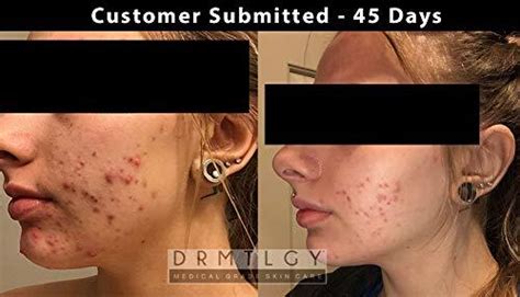 Acne Serum 90% OFF Amazon Code
