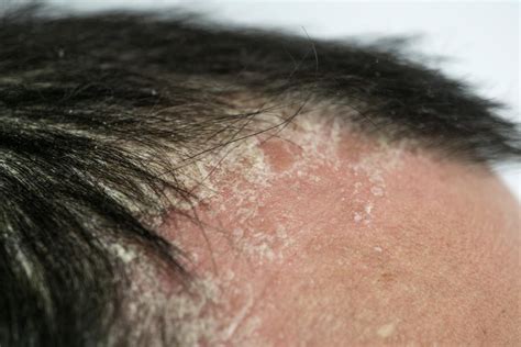 Plaque Psoriasis Scalp Hair Loss