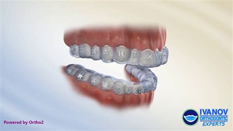 Once your orthodontics have been removed, we recommend using a retainer for a few months to keep your teeth from shifting out of place. How Long Does It Take Teeth To Settle After Braces - Teeth ...