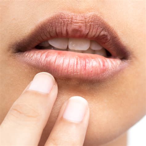 Why Lips Are Dry In Winter